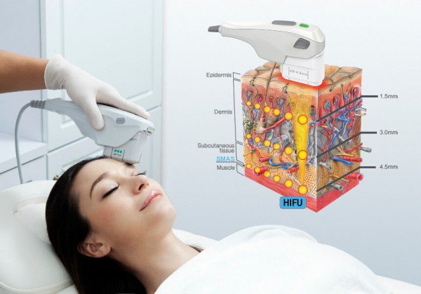 ▲HIFU therapy used to reduce wrinkles and achieve skin tightness